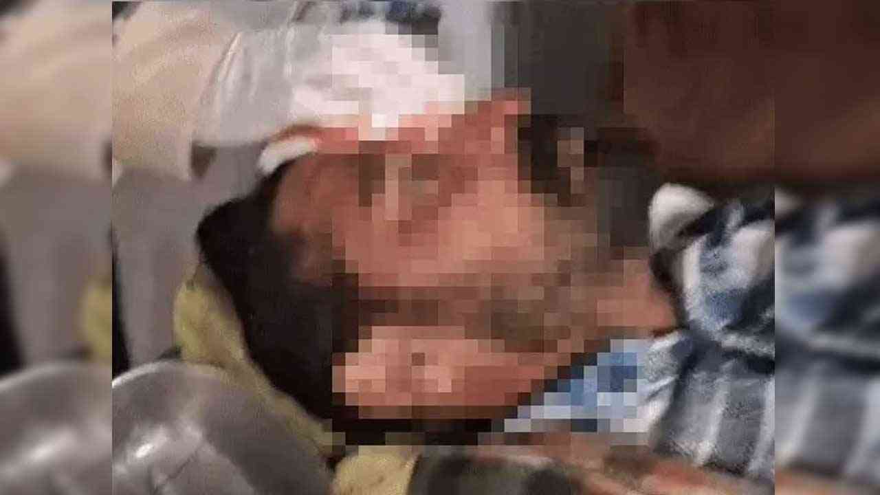 ਗੁਰਦਾਸਪੁਰ ਵਿੱਚ ਚਾਈਨਾ ਡੋਰ ਨਾਲ ਨੌਜਵਾਨ ਗੰਭੀਰ ਜ਼ਖਮੀ, ਮੱਥੇ ਤੇ ਨੱਕ ’ਤੇ 35 ਟਾਂਕੇ